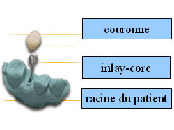 Inlay-core